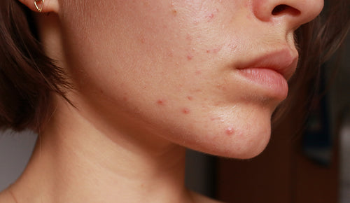 Adult acne – why it happens and what to do about it