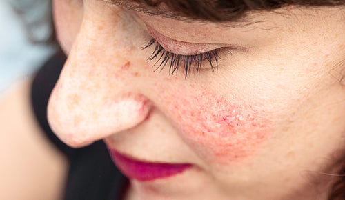 Everything you need to know about redness – from causes to treatments