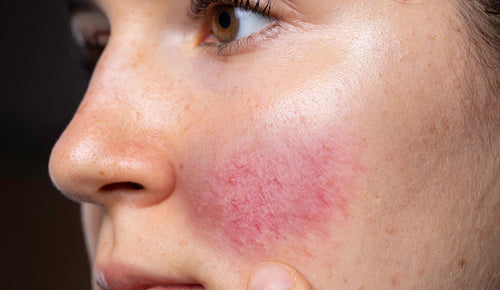 Rosacea: Everything you need to know