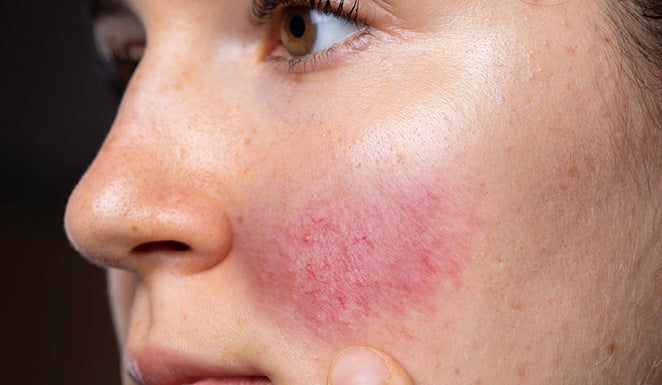 Rosacea: Everything you need to know